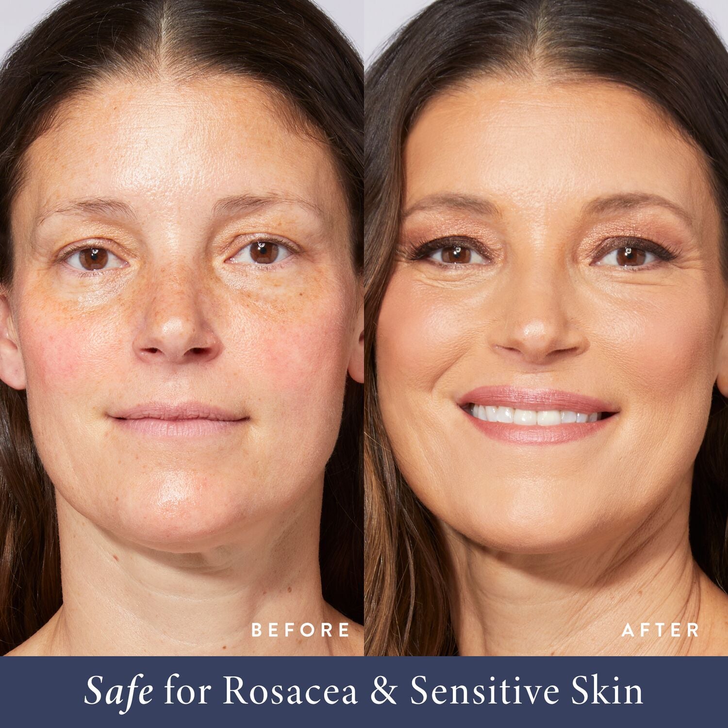 LG-BakedToGo-BalancenBrighten-BeforeAfter_RosaceaandSensitiveskin-ECommerce_JPG_8b239659-8846-4c74-a2d1-5b14d910d09a